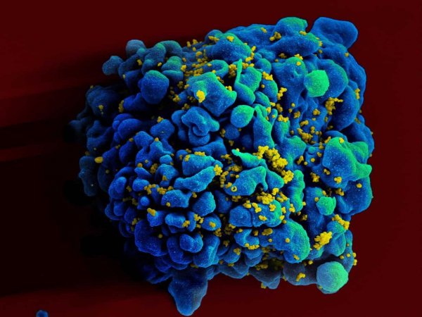 HIV-infected H9 T-cell Scanning electromicrograph of an HIV-infected H9 T cell.
